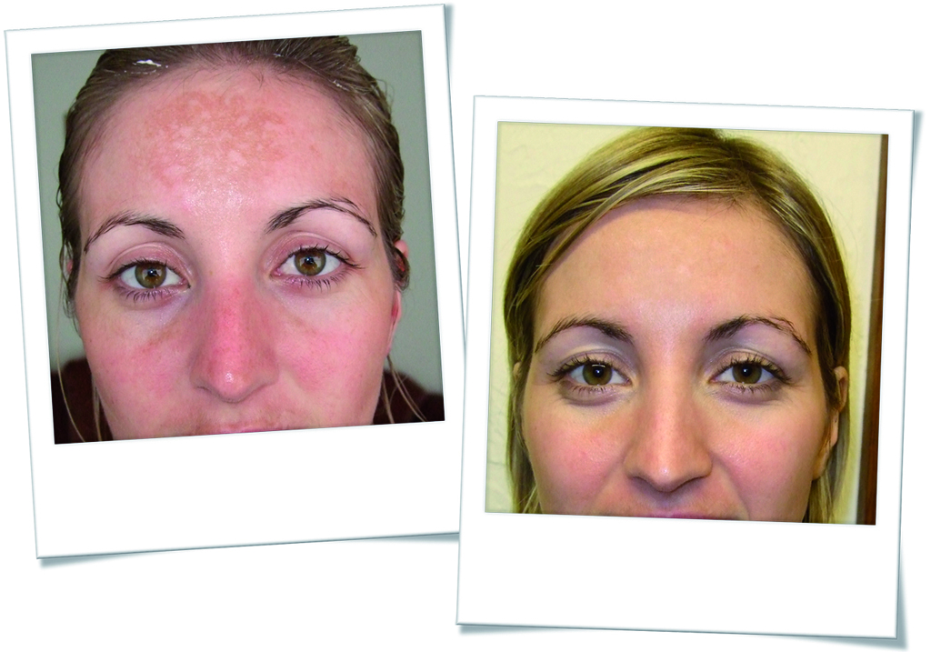 Hannah before and after